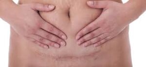 Person proudly displaying their cesarean scar, symbolizing strength and resilience.