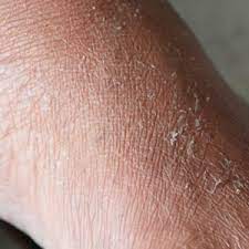 Dry skin on arm, showing flakiness and irritation