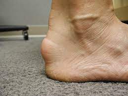 An image showing a close-up of an ankle affected by gout. The ankle appears swollen and red, with visible inflammation and discomfort. 