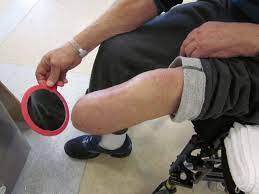 Person in wheelchair preparing to apply prosthetic leg 