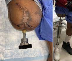  Integration of prosthetic limb with bone