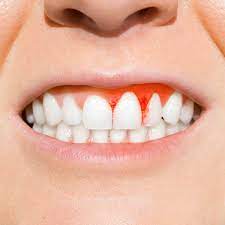 Person displaying bleeding gums, a symptom of gum disease.
