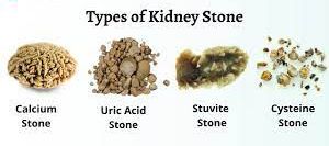 A side-by-side comparison of different kidney stone types, showing their size, shape, and texture variations.