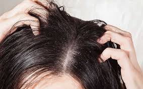 Person with dandruff scratching their scalp