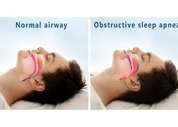 Obstructive sleep apnea demonstration: Recognizing airway blockages during sleep.