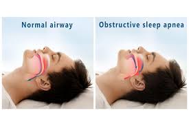 Normal airway and obstructive sleep apnea comparison: Clear passage vs. blocked airflow