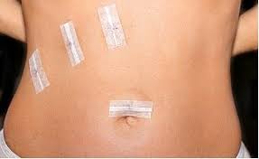 Surgical incisions on the abdomen: Post-operative care and healing process