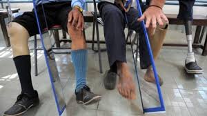Persons with amputation wearing prosthetic legs