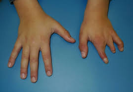 Congenital amputation of hand