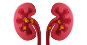 A detailed medical illustration of kidney stones inside the human kidney