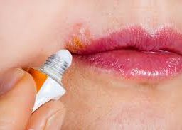 Person applying cream to a cold sore on the mouth