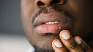 man with cold sore on the bottom lip