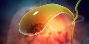 An image showing gallstones within the gall bladder, depicted in a detailed anatomical view. The stones appear as small, irregular, and yellowish formations inside the gall bladder, contrasting with the surrounding tissue in a medical illustration.