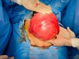 Surgeons extracting a massive fibroid from an abdomen