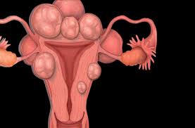 Illustrating uterine fibroids and their appearance within the uterus.