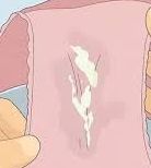 Underwear with vaginal discharge stains - a common sign of yeast infections.