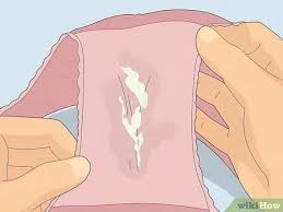 White, cottage cheese-like discharge on fabric, indicative of potential vaginal infection.