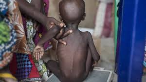 Extremely underweight child suffering from malnutrition.