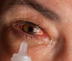 Applying Eyedrops to Alleviate Symptoms
