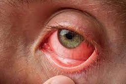 Pink eye Symptoms: Close-Up of Affected Eye