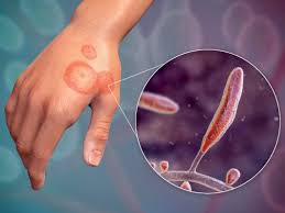 Ringworm rash on a hand – Common fungal infection symptoms along with a microscopic view of dermatophytes 