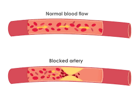  Botched Artery vs. Normal Artery - Understanding the Impact of Cholesterol