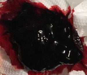 Large blood clot on a tissue