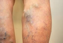 Image showing a blood clot in the leg.