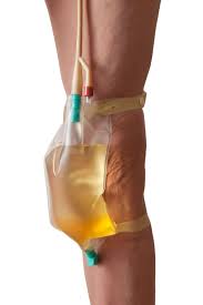 Image of a Foley catheter securely attached to a person's leg with a filled drainage bag, highlighting proper home care.