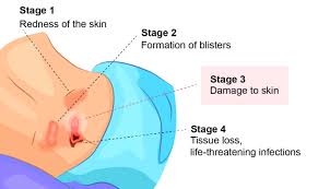 Illustration depicting progression through the stages of pressure ulcers