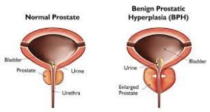 Image depicting a normal prostate gland in optimal health and an enlarged prostate due to BPH (Benign Prostatic Hyperplasia)