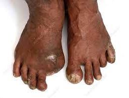 Amputated toe due to health neglect and diabetes complications