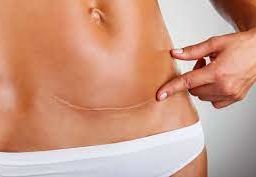 C-section Incision: A healed scar showcasing postoperative recovery.