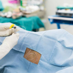 Epidural anesthesia: Person receiving epidural medication for pain relief