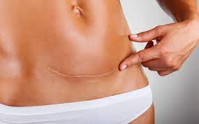 Woman pointing at her fully healed C-section incision post-recovery