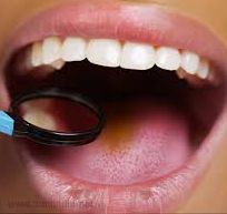 Dry mouth examination with mirror - checking lips and oral cavity for dryness