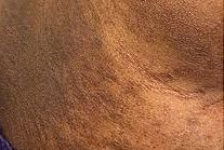 Eczema on the lower back, showing inflamed and itchy patches of skin commonly affected by this skin condition.