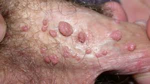 A close-up medical illustration of human skin showing genital warts caused by HPV. The warts appear as small, flesh-colored or slightly raised bumps on the genital area. 