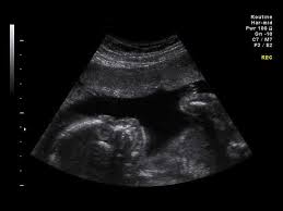 A grayscale ultrasound scan showing internal human anatomy with a focused view on reproductive organs. The image features varying shades of gray, representing different tissue densities, with a curved probe-generated display typical of medical ultrasounds.