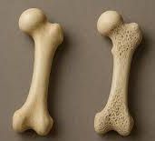 Osteoporosis bone: healthy vs weak bones