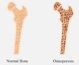 Osteoporosis bone density comparison healthy vs weak bones
